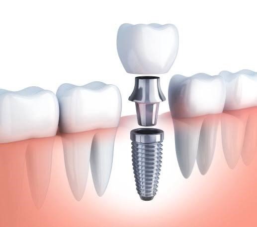 Restorative dentistry has come so far in innovation and design. We’re able to create teeth that blend in with your existing smile, taking into account size, shape, and color.