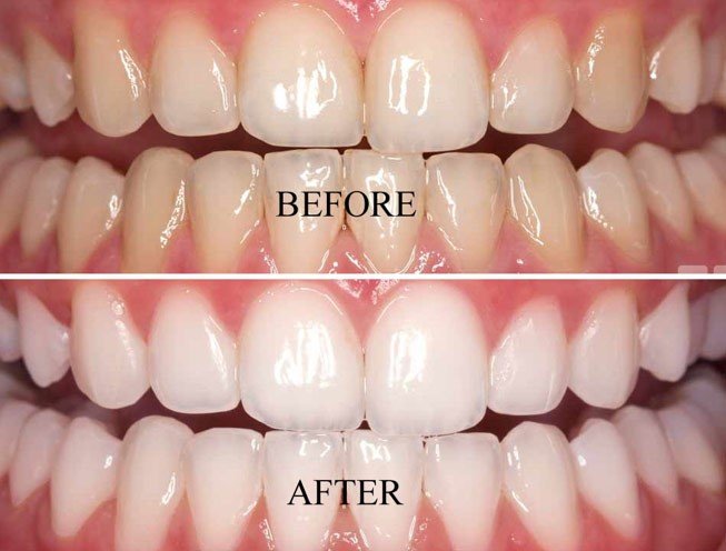 We Offer Powerful Professional Teeth Whitening Treatments At Uppal Dental Clinic .