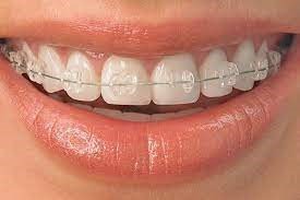 braces treatment