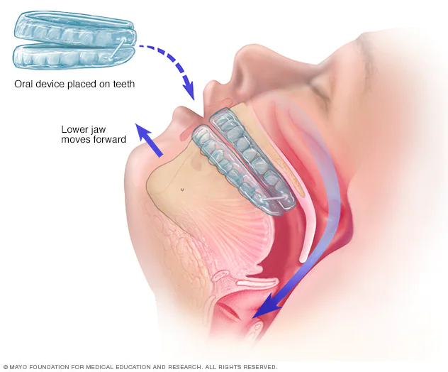 Sleep Apnea