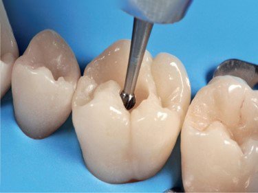 Restore tooth structure, restore your health.​