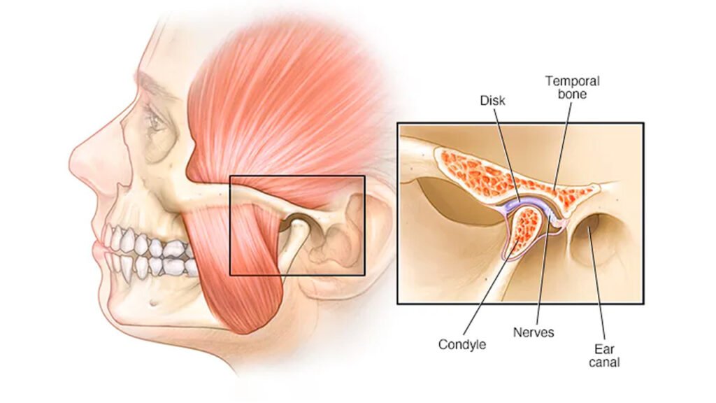 Temporomandibular Joint (TMJ) Disorders