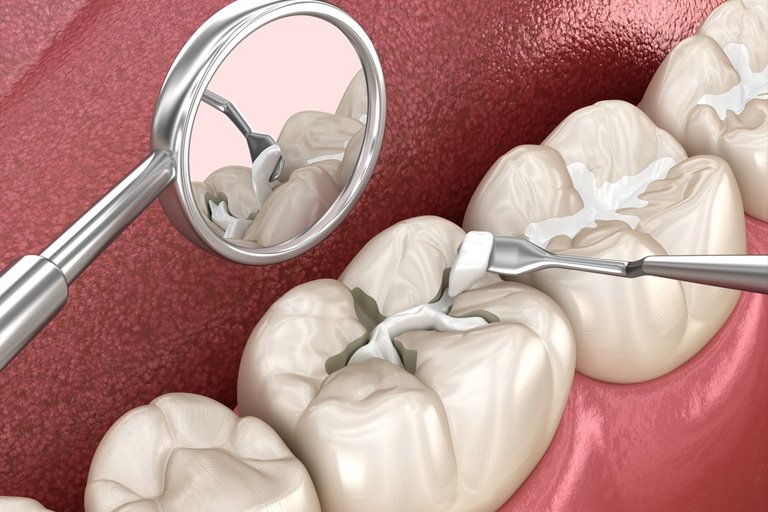 When Is A Dental Filling Necessary?