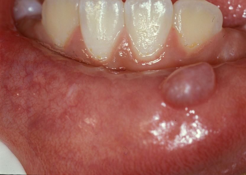 Diagnosis of Oral Cysts