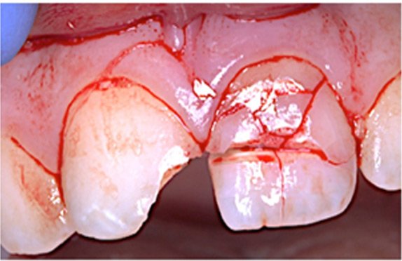 Different-types-of-tooth-fracture