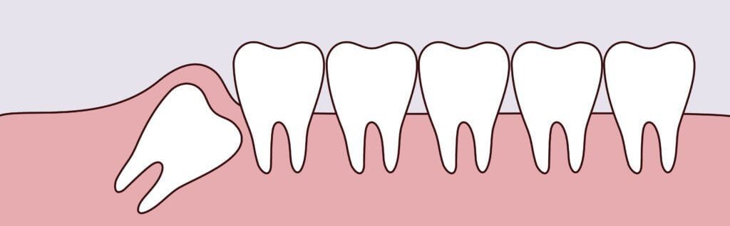 Why Do We Have Wisdom Teeth?