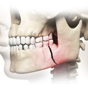 • Fractures to the socket wall, maxilla, and mandible