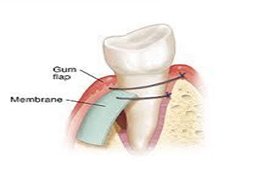 Guided tissue regeneration