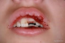 • Laceration of the lips and gingival