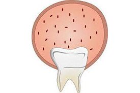 Oral Tumours And Cystsss