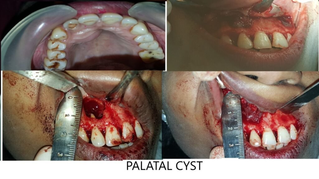 Treatment of Oral Cysts