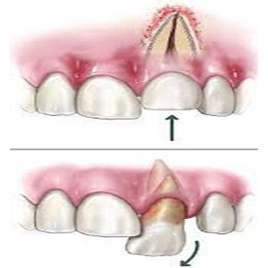 Different types of tooth fracture